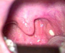 tonsillolith tonsillolith