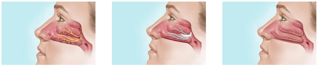 後鼻神經阻斷術適應症一覽圖